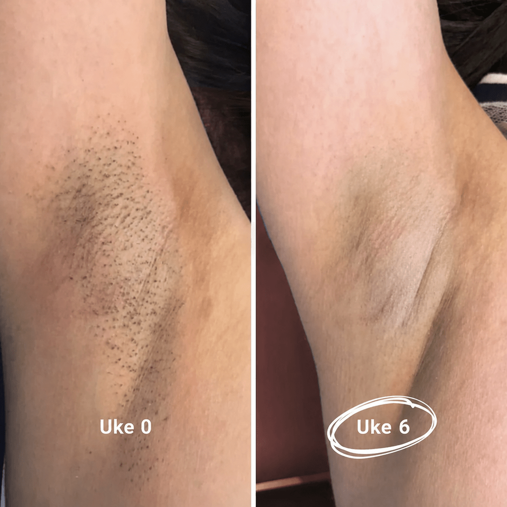 IPL - Permanent hårfjerner - AVABeauty.no
